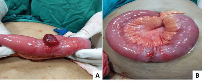 Richters hernia