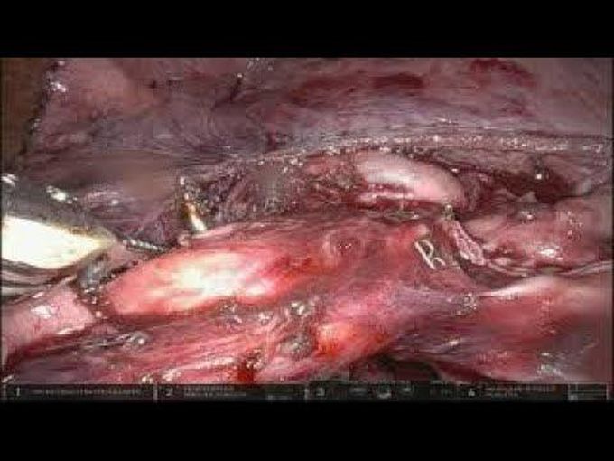 Complex Robotic-Assisted Right Lower Lobe Basilar Segmentectomy in the Setting of Prior Laryngectomy