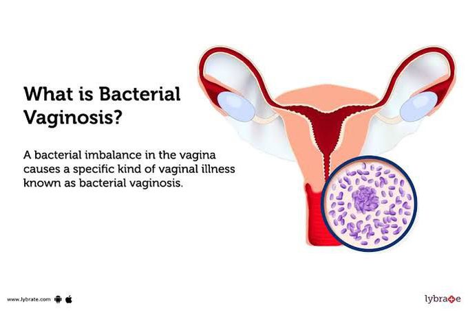 Bacterial vaginosis