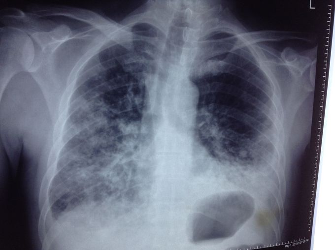Diabetic pt € dyspnea