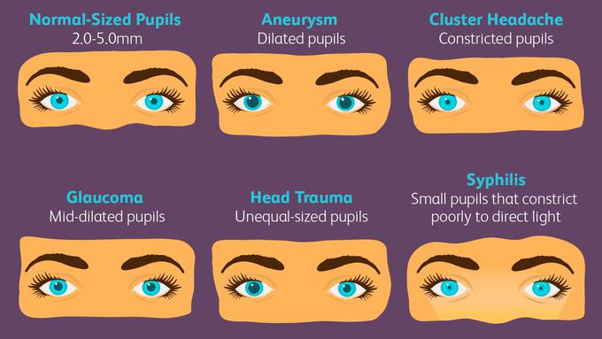 What are the most common causes of anisocoria?