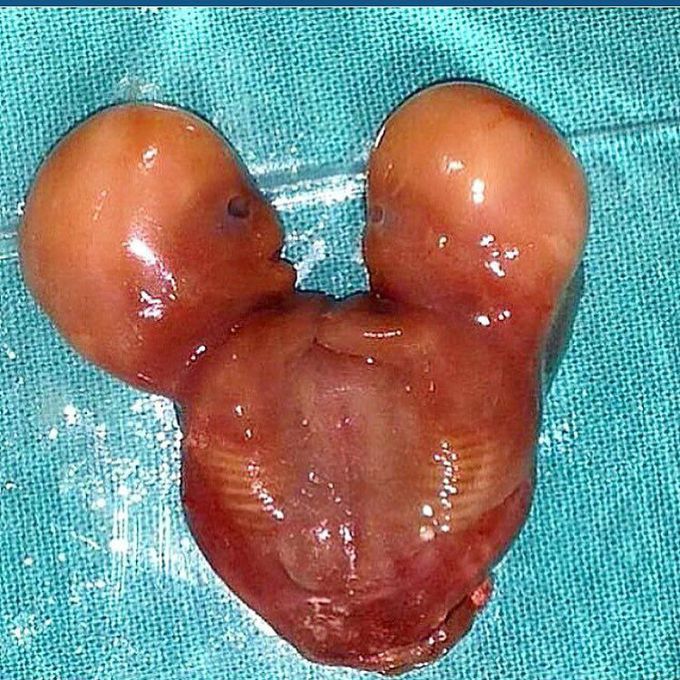 Conjoined twins