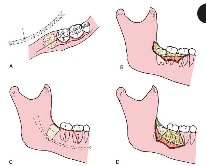 Impacted 3rd molar removal