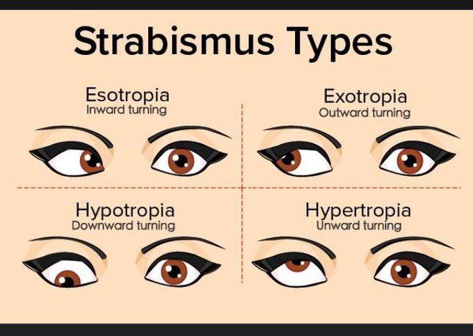 Types of Strabismus