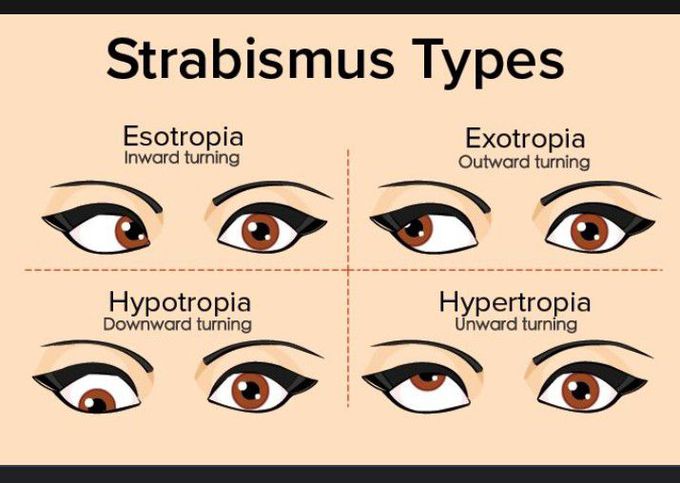 Types of Strabismus