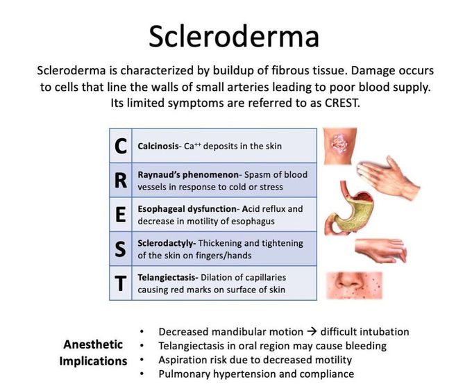 Scleroderma