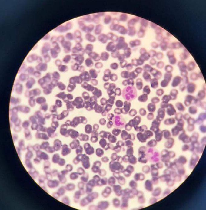 Pregnant neutrophil