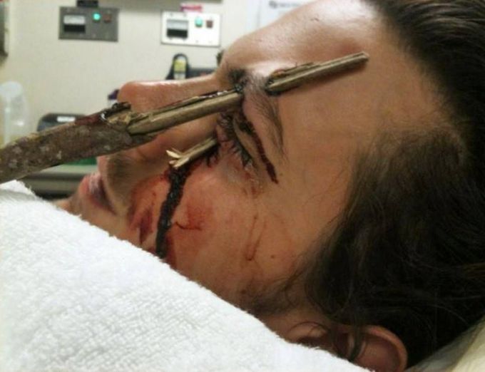 Tree fall injury that almost cost this man's eye!