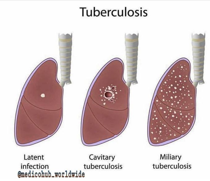 Tuberculosis