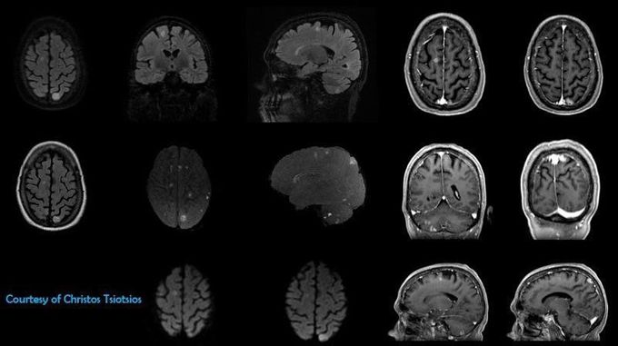 Multiple brain metastases