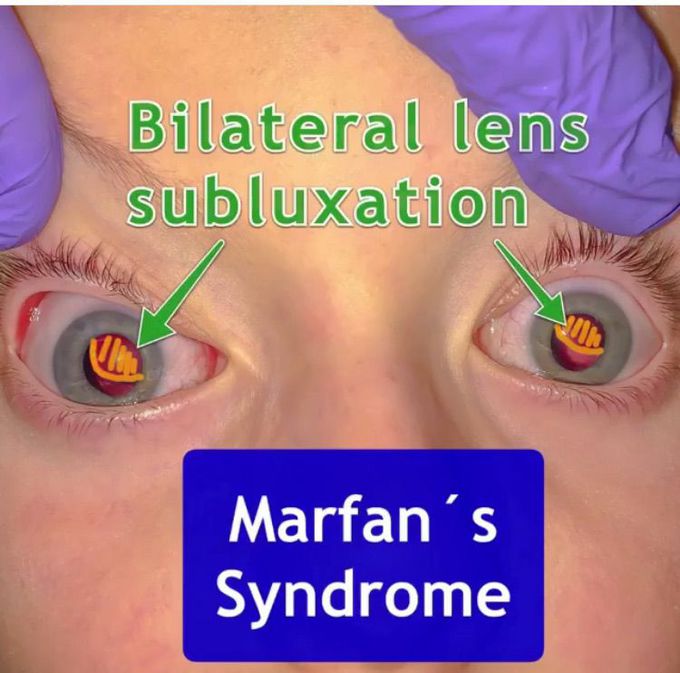 Marfan syndrome