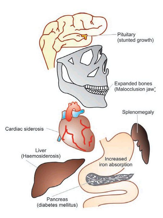 β-thalassaemia major.