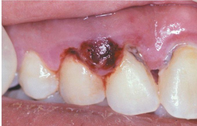 Periodontal Abscess