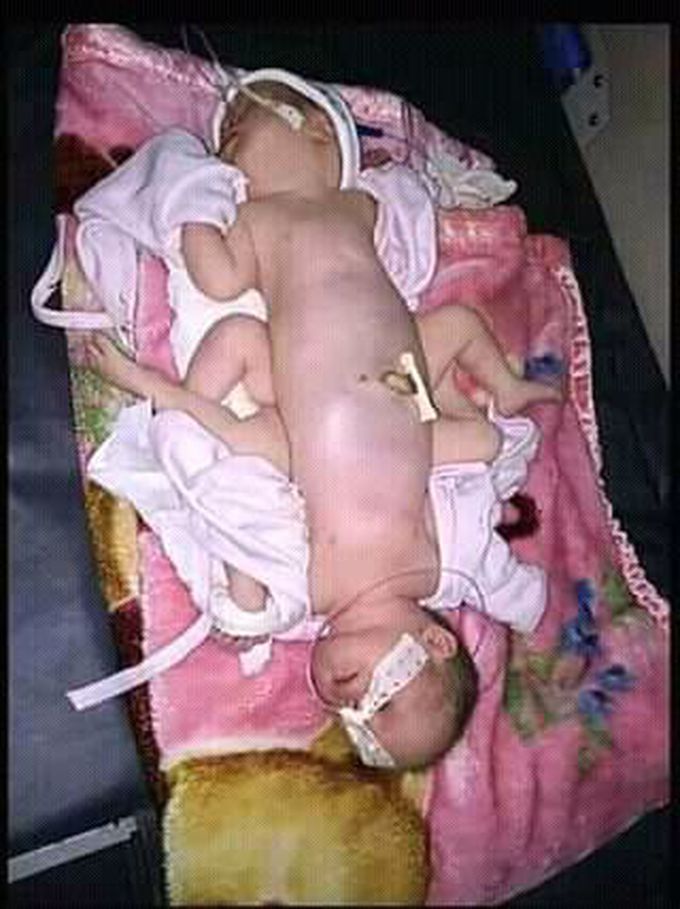 Children birth problem