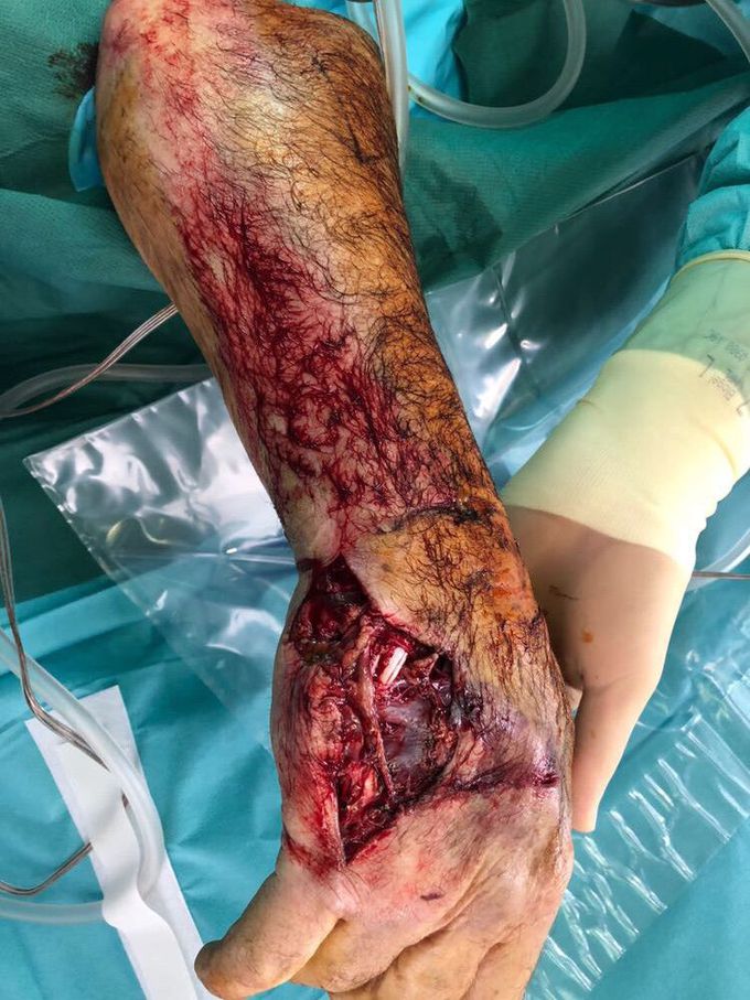 crush injuries