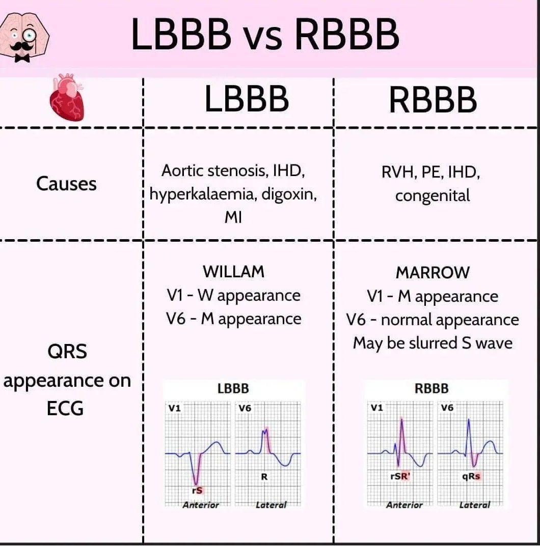 LBBB Vs RBBB MEDizzy