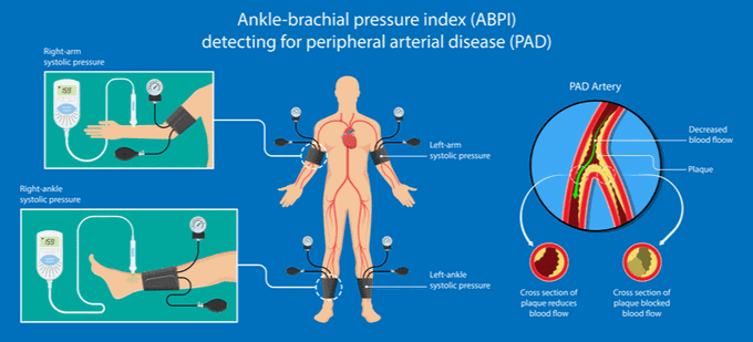 The Ankle-Brachial Pressure Index