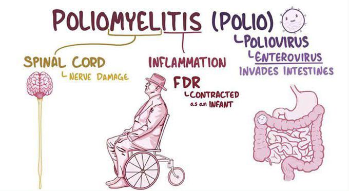 Poliomyelitis