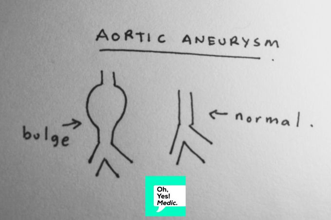 Aortic Aneurysms