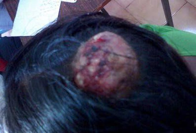 Cocks peculiar tumor