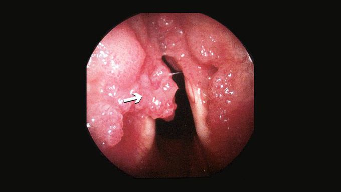 Symptoms of respiratory papillomatosis