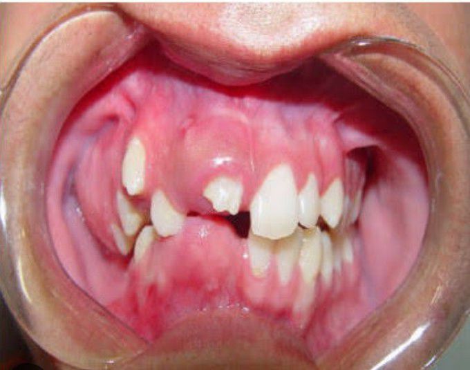 Regional odontodysplasia