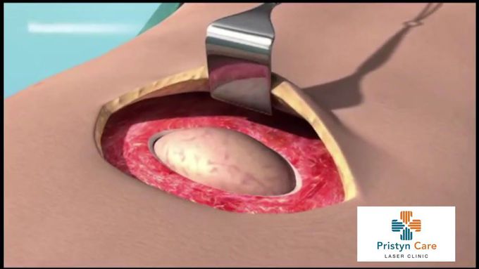 Hernia Treatment using 3D Mesh | हर्निया | Hernia Surgery in Gurgaon | Pristyn Care
