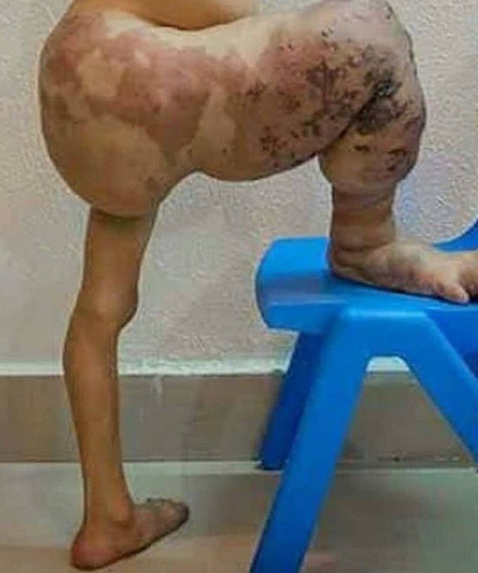 Klippel–Trénaunay syndrome