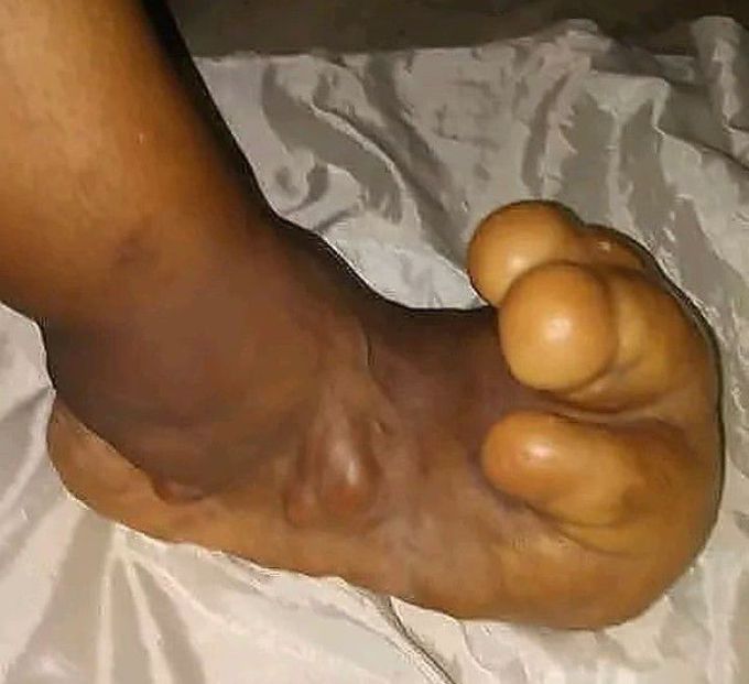 Rocker-bottom Foot