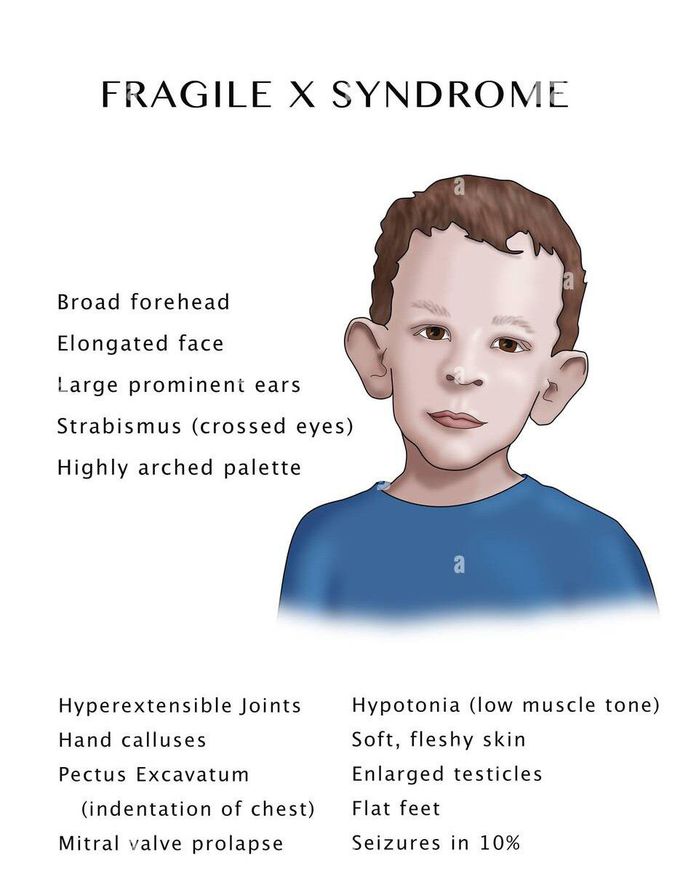 Fragile X syndrome