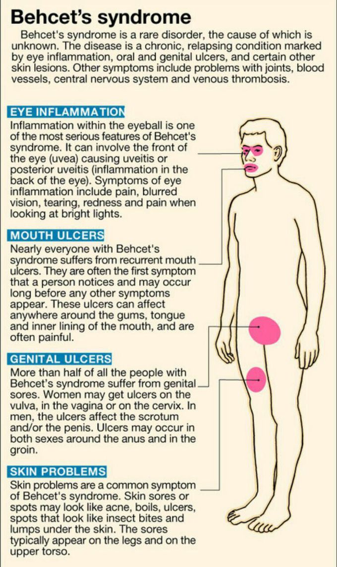 Bahcets syndrome