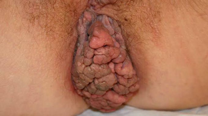 Anal warts
