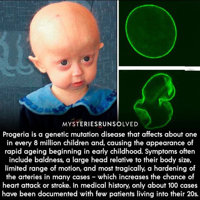 PROGERIA