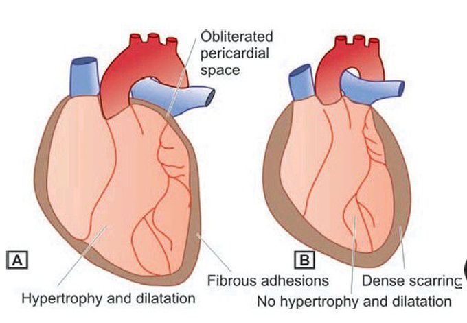 Heart and the pericardium