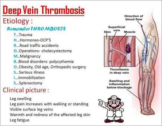 Mnemonic: THROMBOSIS