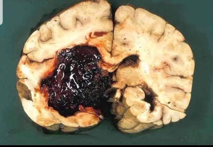 Cerebral Section With Blood Clot