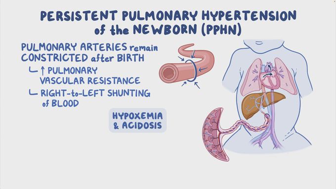 Signs and Symptoms of PPHN