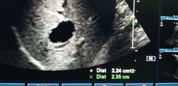 Liver ultrasound