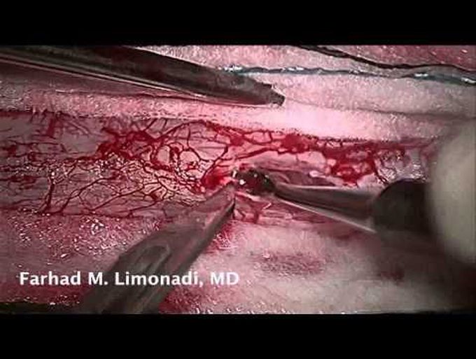 Spinal Cord Tumor Resection (spine surgery) Case Presentation: Spine Tumor intradural-extramedullary