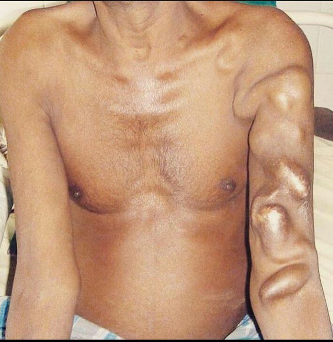 Multiple aneurysm of AV fistulas