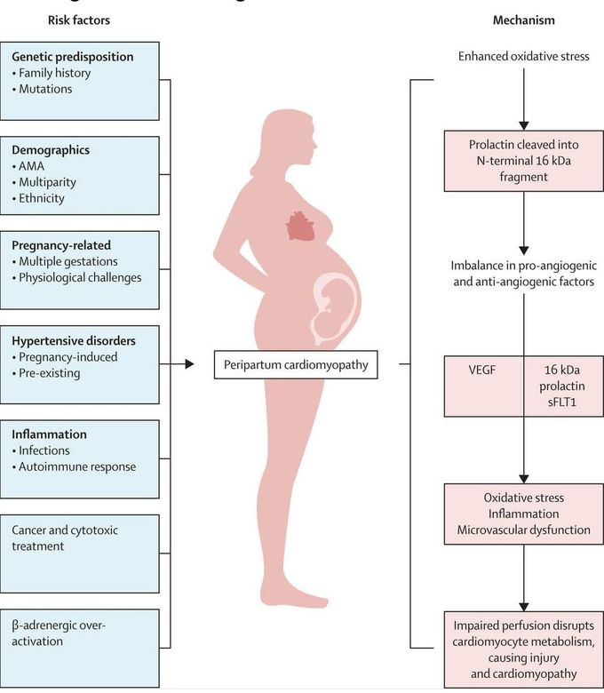 Peripartum Cardiomyopathy