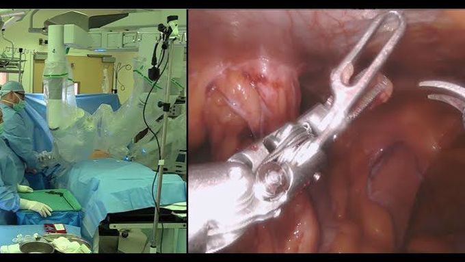Robotic Hernia Repair