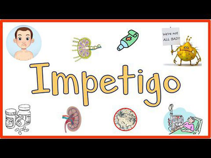 Impetigo and its Treatment