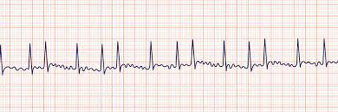 Causes of Atrial Fibrillation