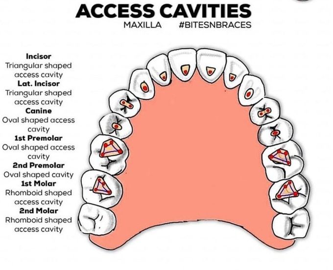 Access Cavity- Maxilla