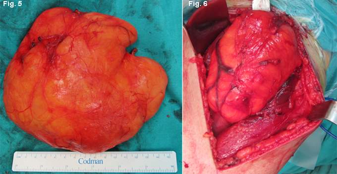 Liposarcoma