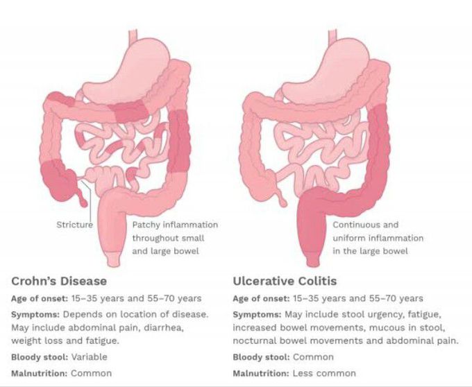 Crohn's VS Ulcerative colitis
