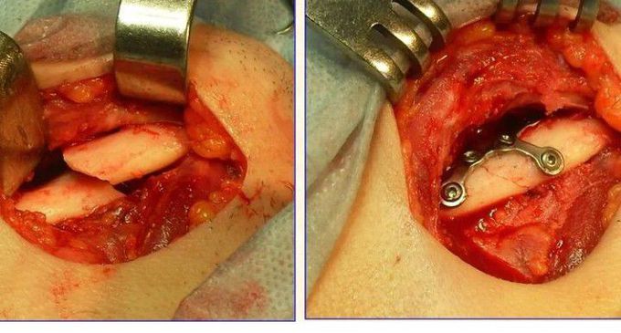 Lower jaw fracture