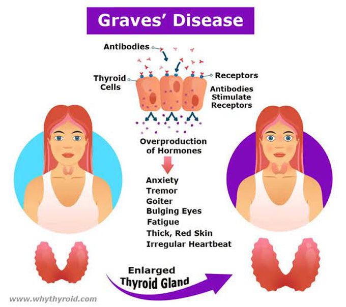 Graves Disease