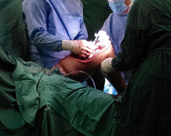Knee tumor